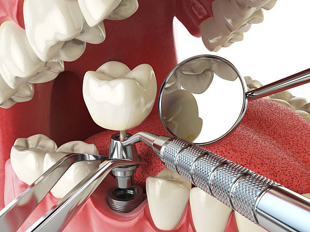 Best Emergency Root Canal Treatment in Granville South, OH